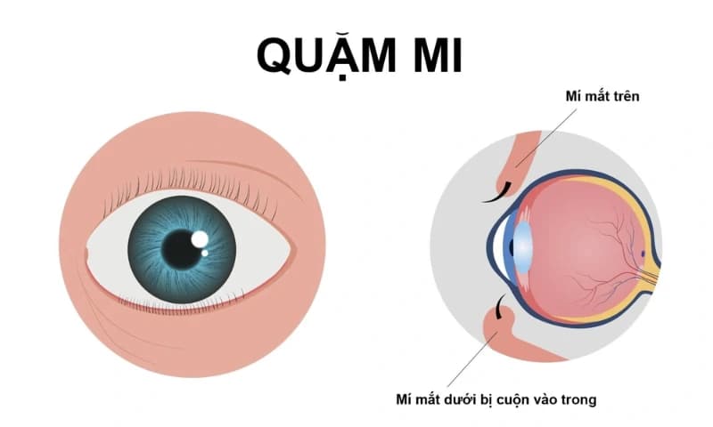 Quặm mi - khi lông mi âm thầm "cào xước" giác mạc mỗi ngày