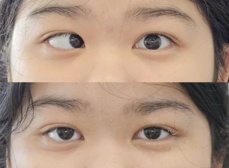 Lác (lé) mắt – có thể điều trị được không?