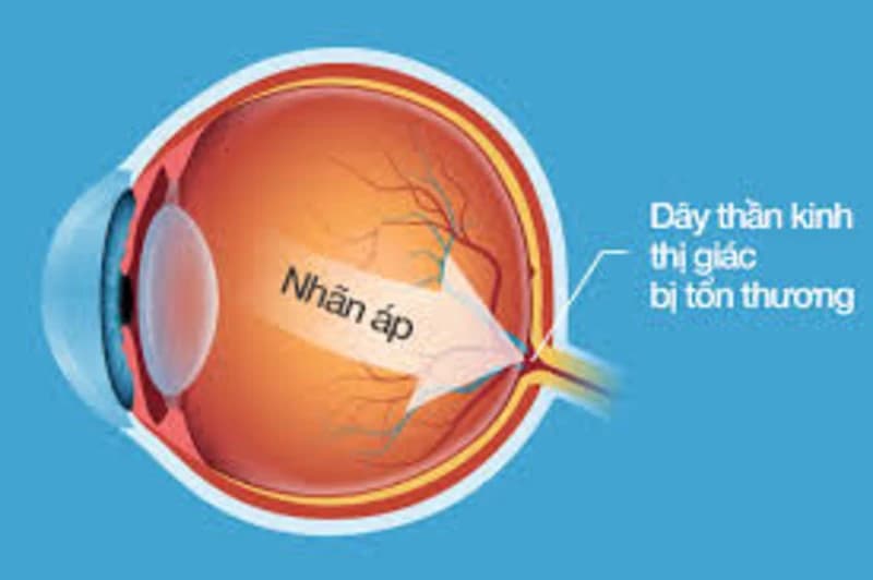 TỔNG QUAN VỀ BỆNH TĂNG NHÃN ÁP GLOCOM ( THIÊN ĐẦU THỐNG)