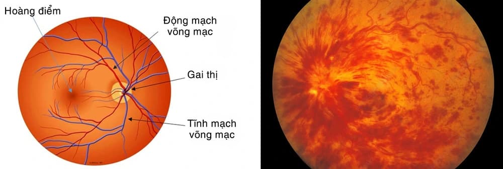 Tắc tĩnh mạch võng mạc: Nguyên nhân, dấu hiệu nhận biết và phương pháp điều trị hiệu quả