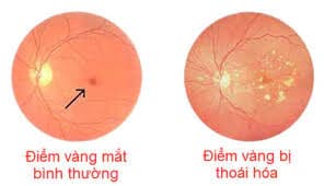 THOÁI HÓA ĐIỂM VÀNG: DẤU HIỆU NHẬN BIẾT VÀ CÁCH PHÒNG NGỪA