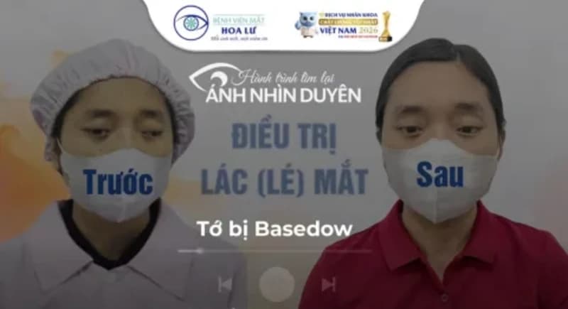 Mắt lác khiến tôi tự ti và stress đến mức phải nghỉ việc