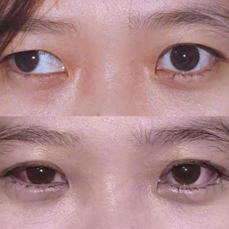 Hành trình tìm lại ánh nhìn duyên và sự tự tin nhờ vào phẫu thuật điều trị lác (lé)