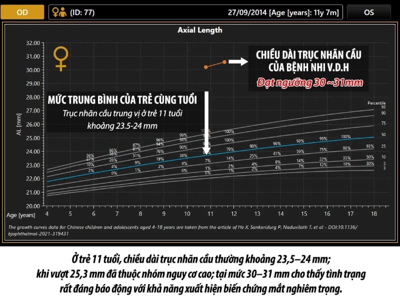 Biến chứng võng mạc do cận thị nặng ở trẻ em: Cảnh báo từ trường hợp bệnh nhi 11 tuổi tại Bệnh viện Mắt Hoa Lư
