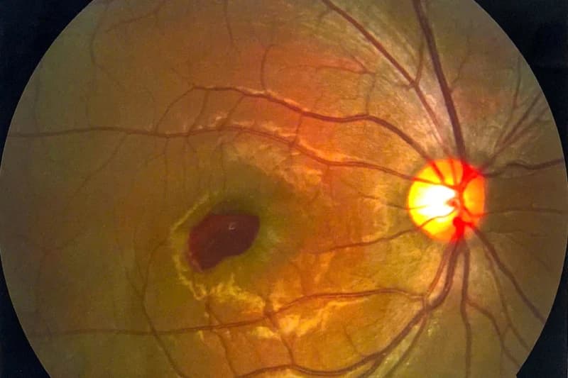 Nam thanh niên “cháy mắt” do đèn laser chiếu, suýt bị mù