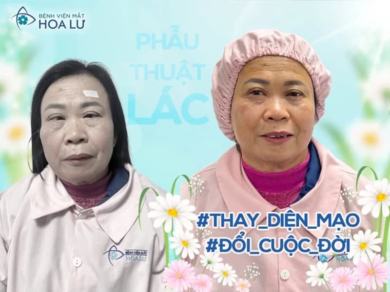 PHẪU THUẬT LÁC