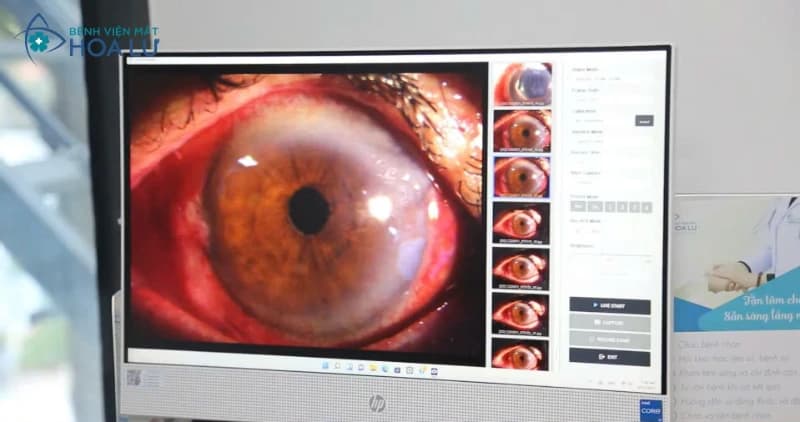 PHẪU THUẬT CỐ ĐỊNH THỂ THỦY TINH NHÂN TẠO