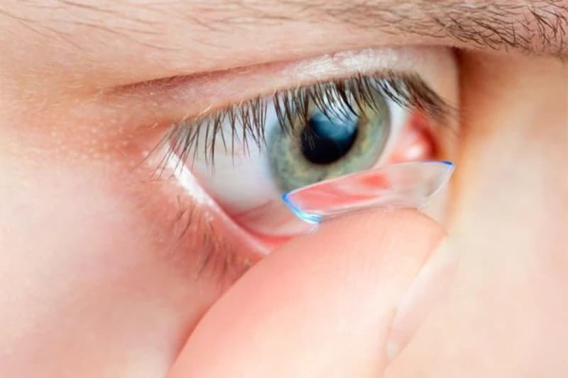 ĐEO KÍNH ÁP TRÒNG BAN ĐÊM ORTHO-K CHỮA CẬN THỊ – NÊN HAY KHÔNG?