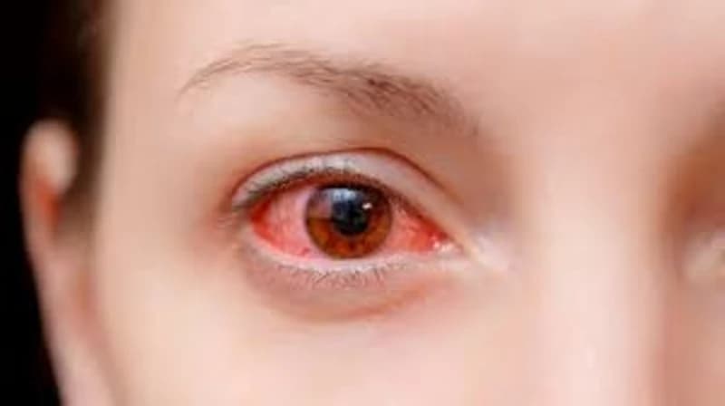 NHỮNG ĐIỀU CẦN BIẾT VỀ VIÊM KẾT MẠC CẤP TÍNH