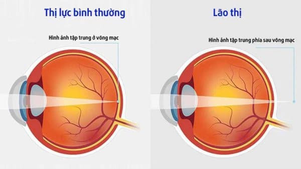 PHÂN BIỆT VIỄN THỊ VÀ LÃO THỊ