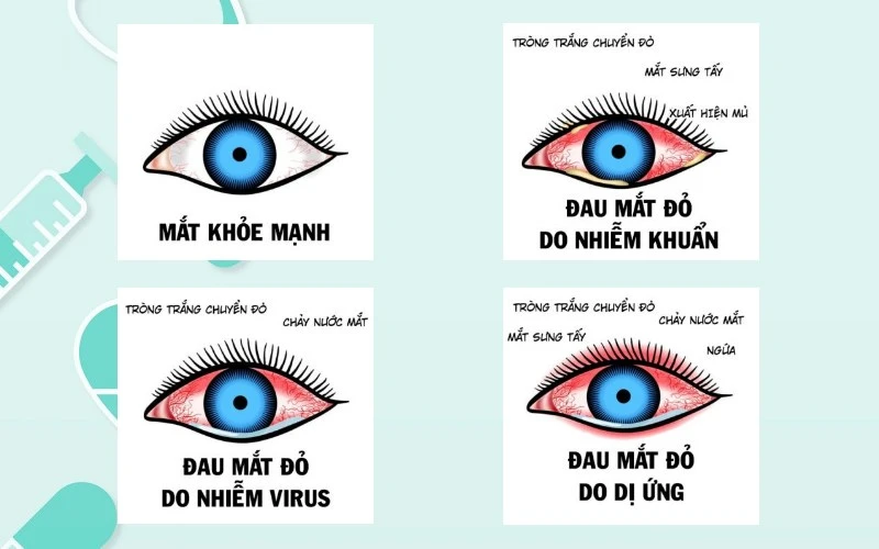 1791268357046-bi-dau-mat-do-bao-lau-thi-khoi-dieu-can-biet-ve-viem-ket-mac-202204041359279958-20260617-131709-102-4180-6364a19f.webp