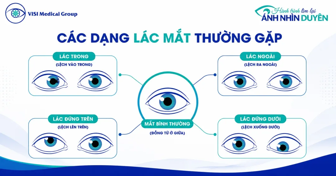 1790659845955-cac-hinh-thai-le-lac-mat-thuong-gap-897ed7e0.webp