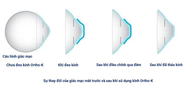 dieu-chinh-tat-khuc-xa-khong-phau-thuat-bang-kinh-ortho-k-co-that-su-tot-khuc-tat-2-1568953672-796-width660height305_20260617_125043_385.webp